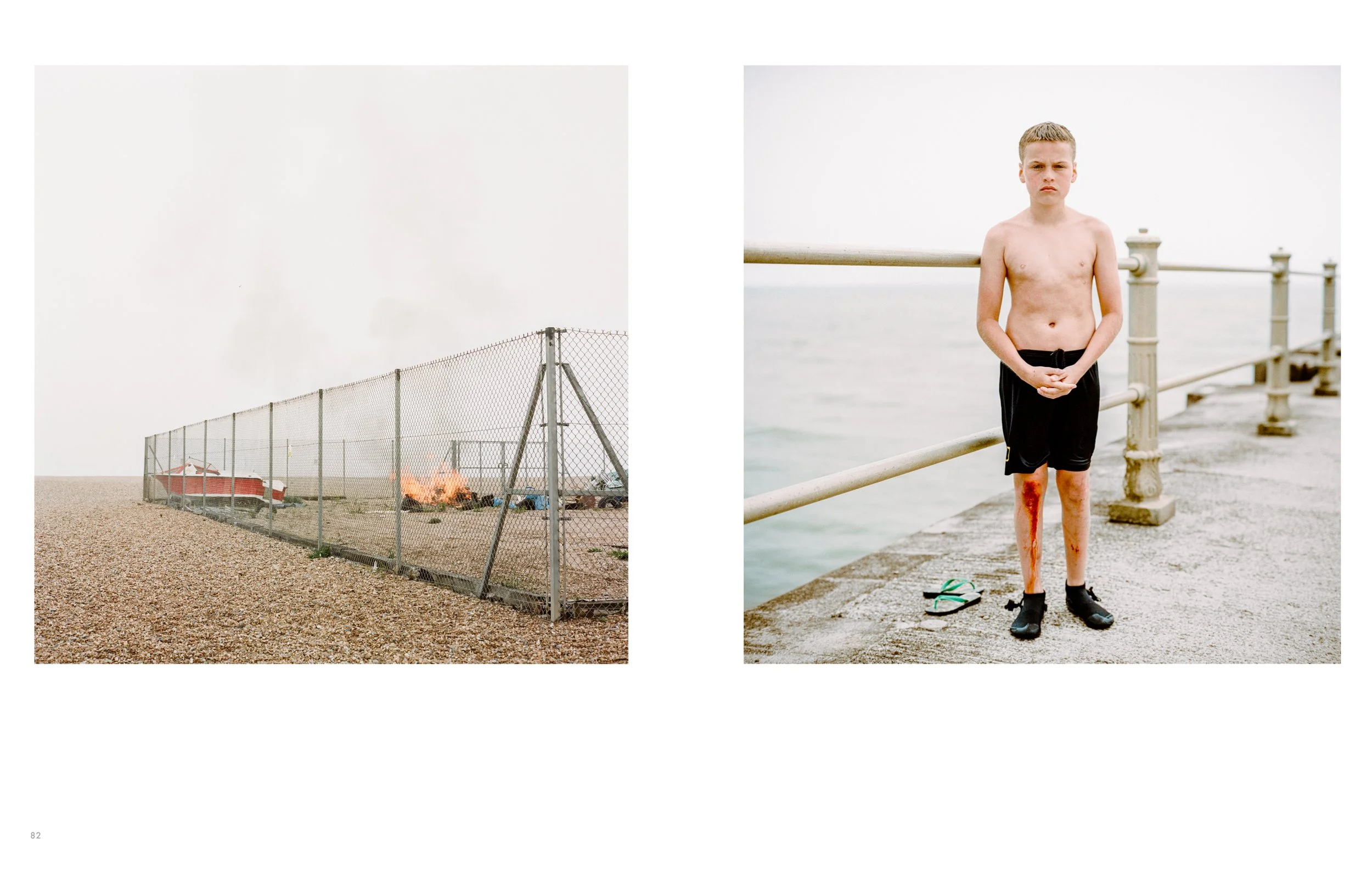 A boy standing shirtless on a pier with a railing, with a large bruise or injury on his right leg and with sea water in the background.