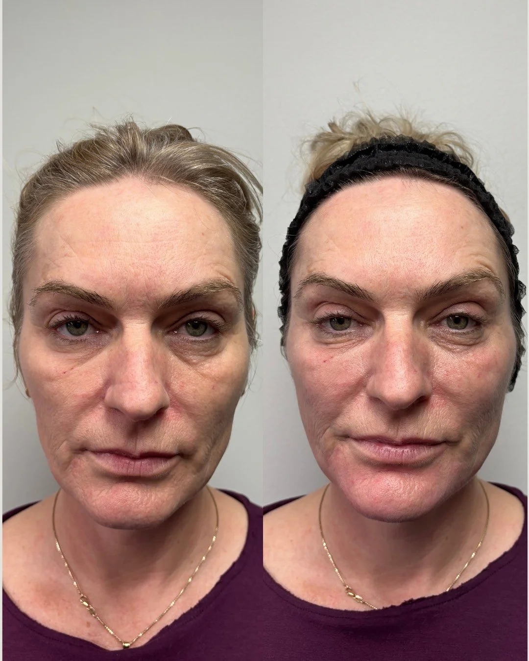 JUVEDERM VOLUMA, JUVEDERM VOLUX, RESULTS 2+ YEARS 