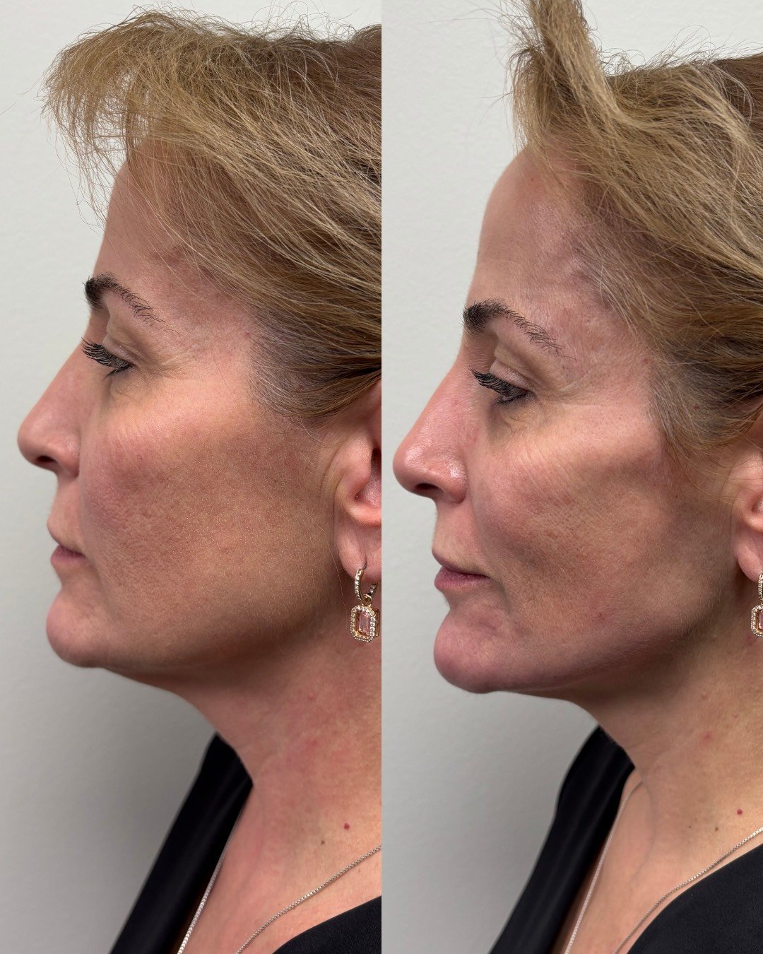 JUVEDERM VOLUMA, JUVEDERM VOLUX, RESULTS 2+ YEARS 