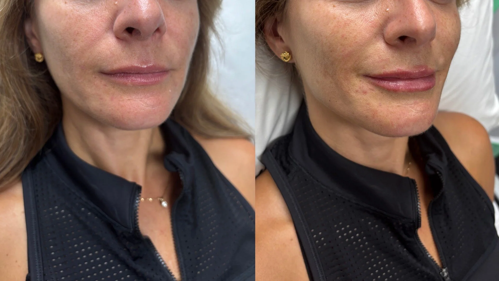 SCULPTRA, RESTYLANE KYSSE