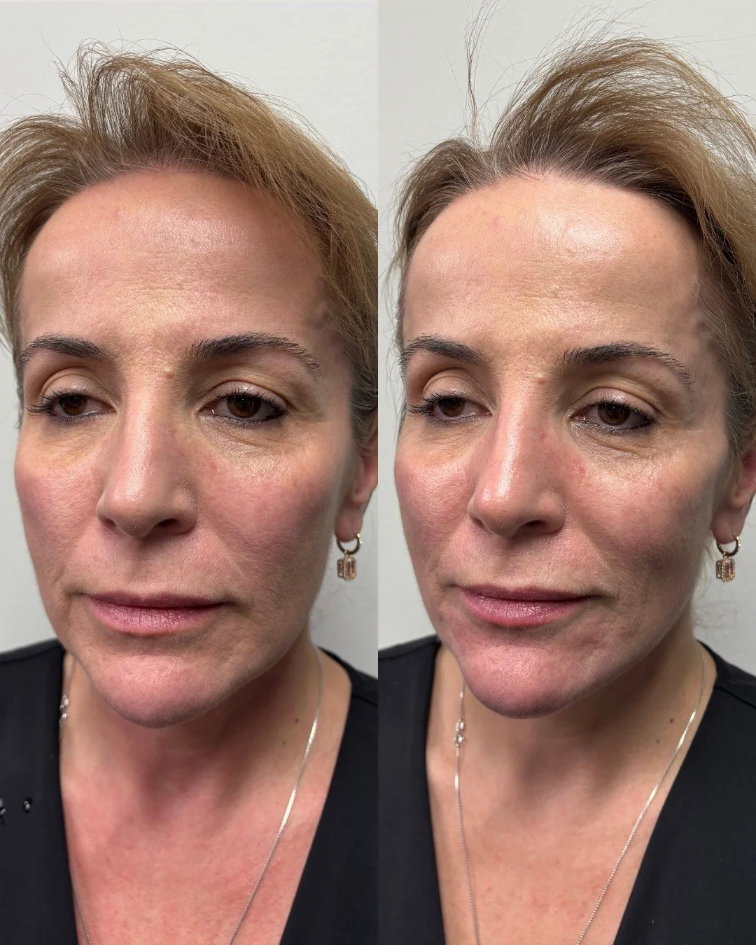 JUVEDERM VOLUMA, JUVEDERM VOLUX, RESULTS 2+ YEARS 