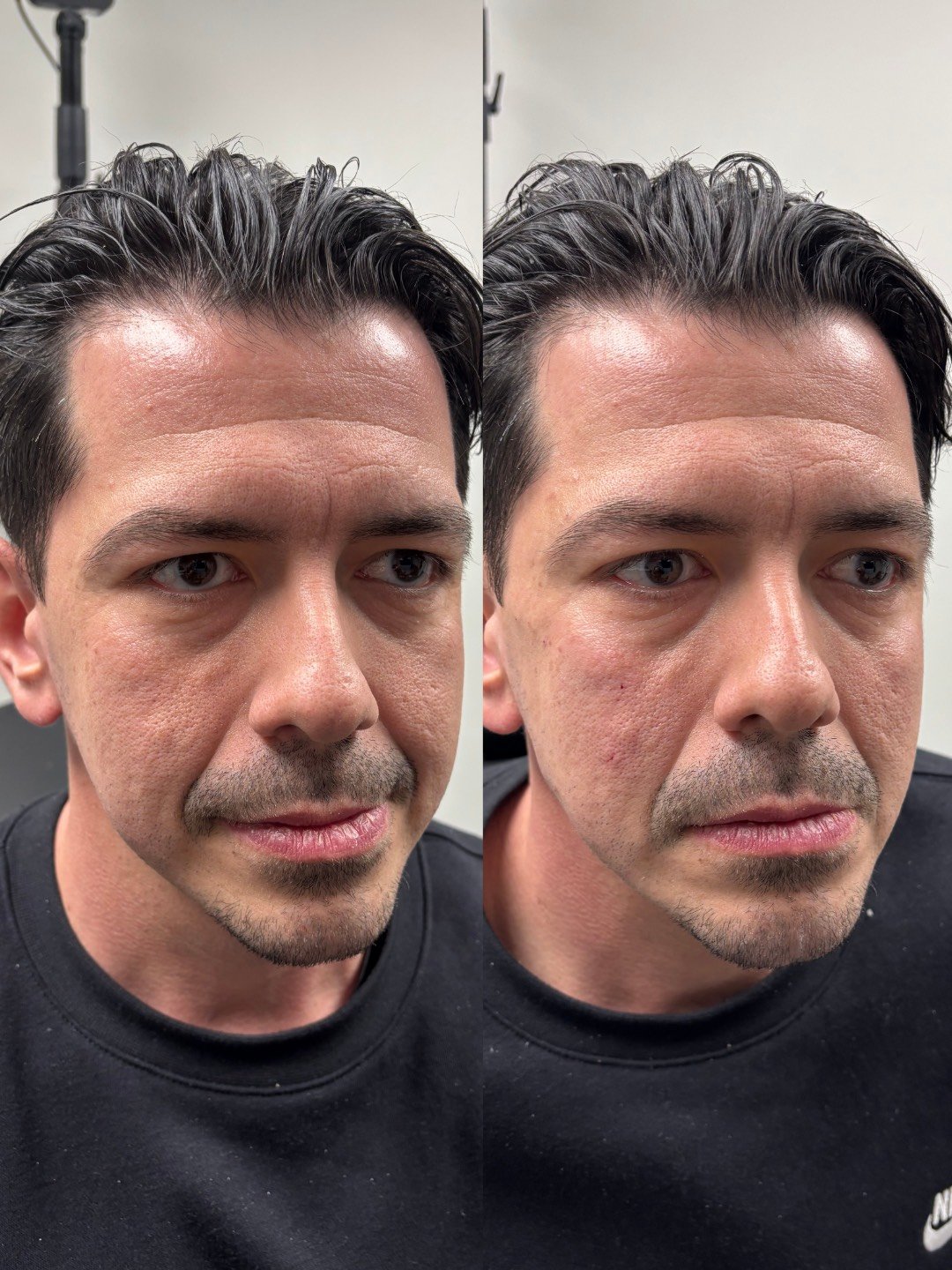 JUVEDERM VOLUMA, JUVEDERM VOLUX, RESULTS 2+ YEARS  