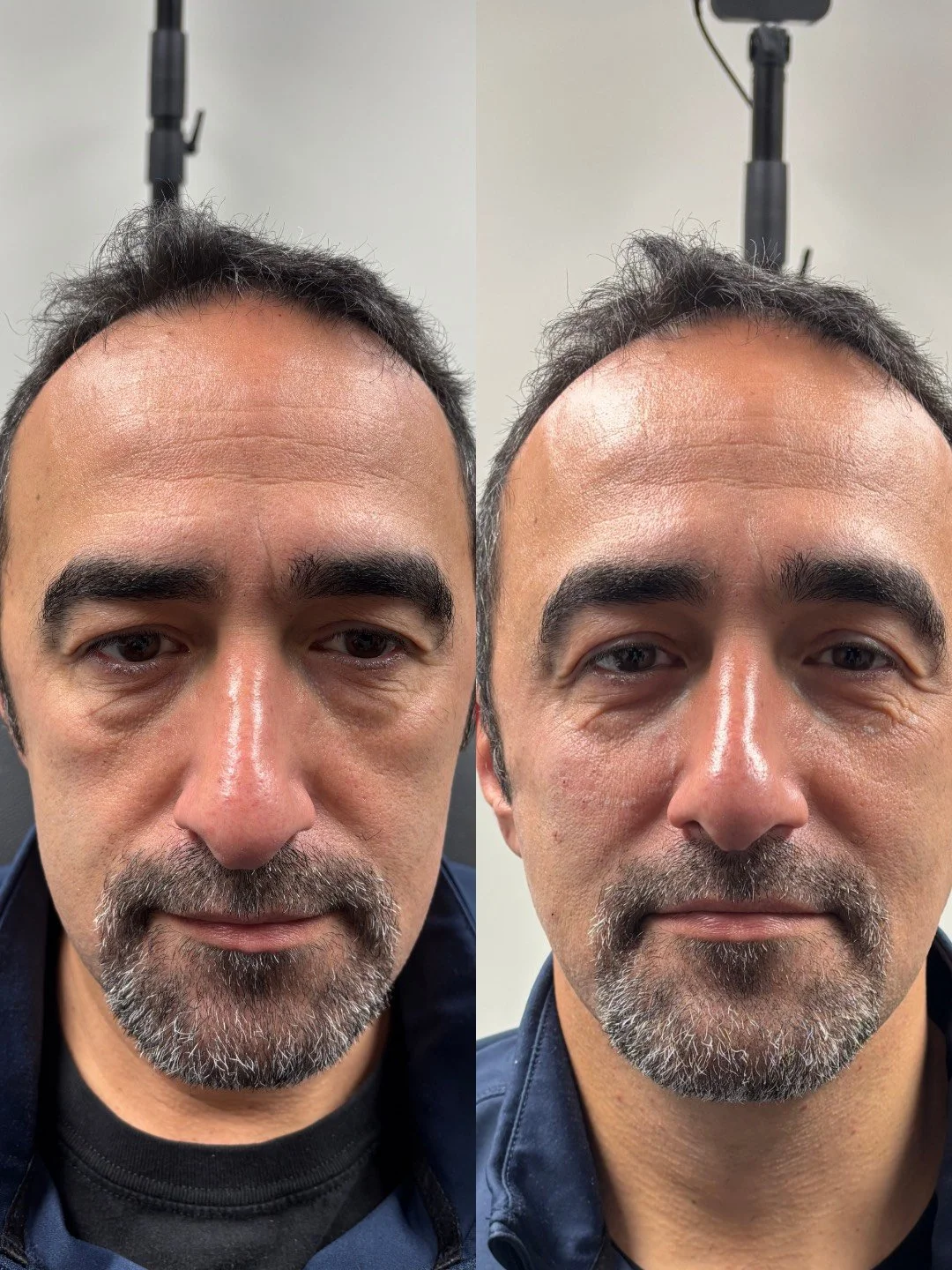 JUVEDERM VOLUMA, JUVEDERM VOLUX, RESULTS 2+ YEARS 