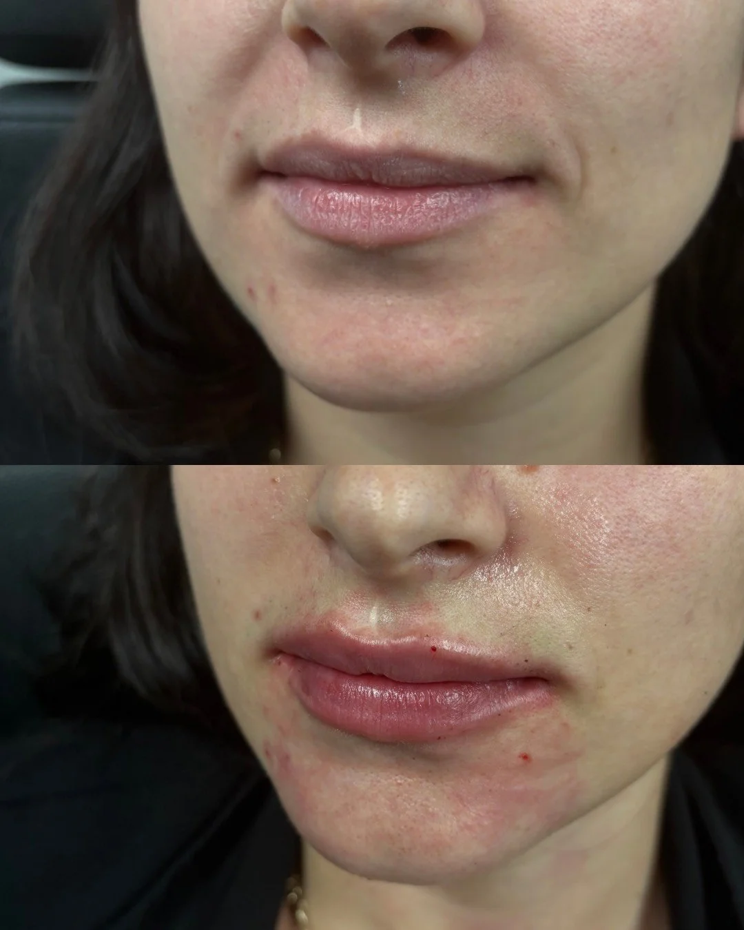 JUVEDERM ULTRA