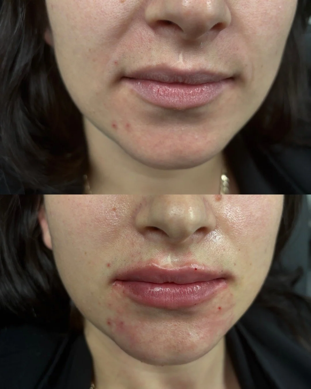 JUVEDERM ULTRA