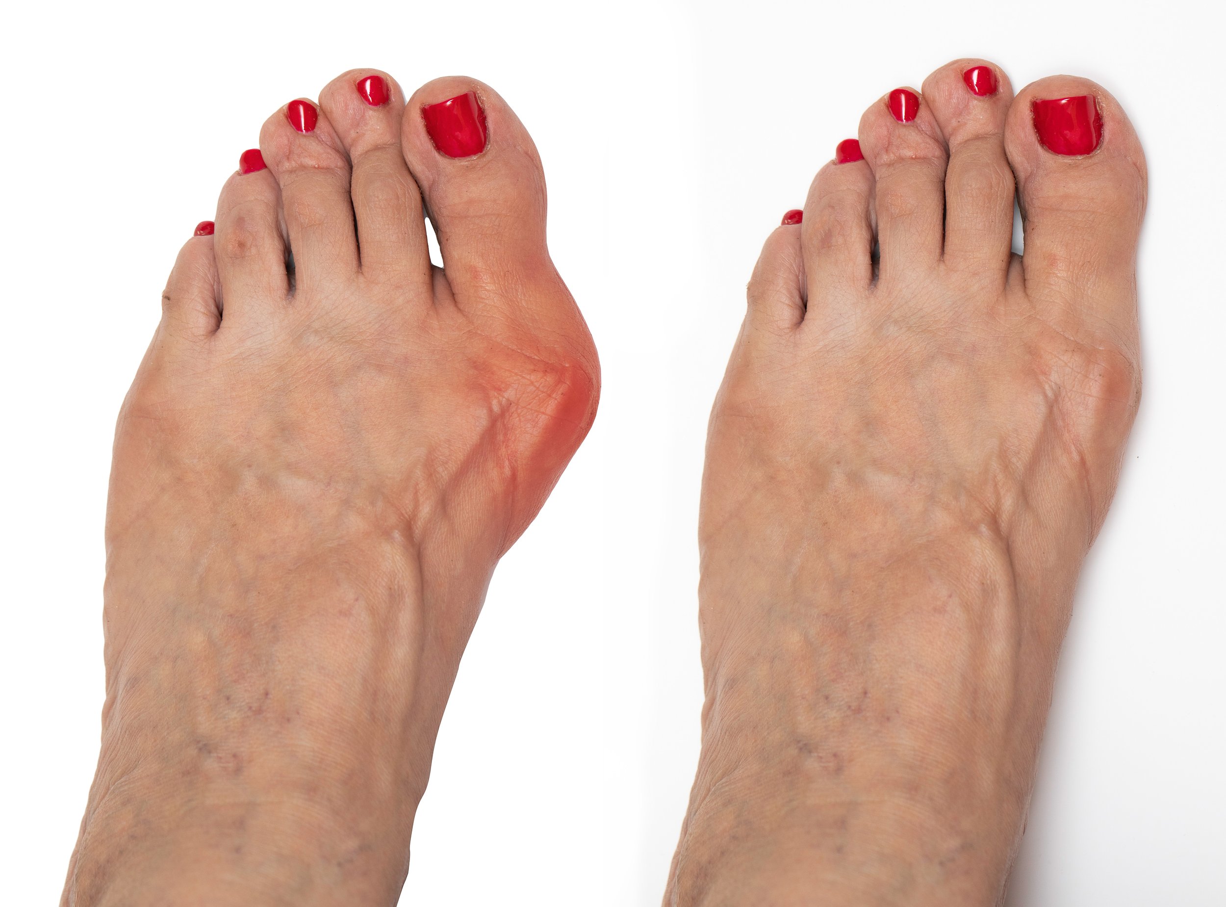 closeup-view-bare-foot-elderly-woman-suffering-from-hallux-valgus-before-after-surgery.jpg