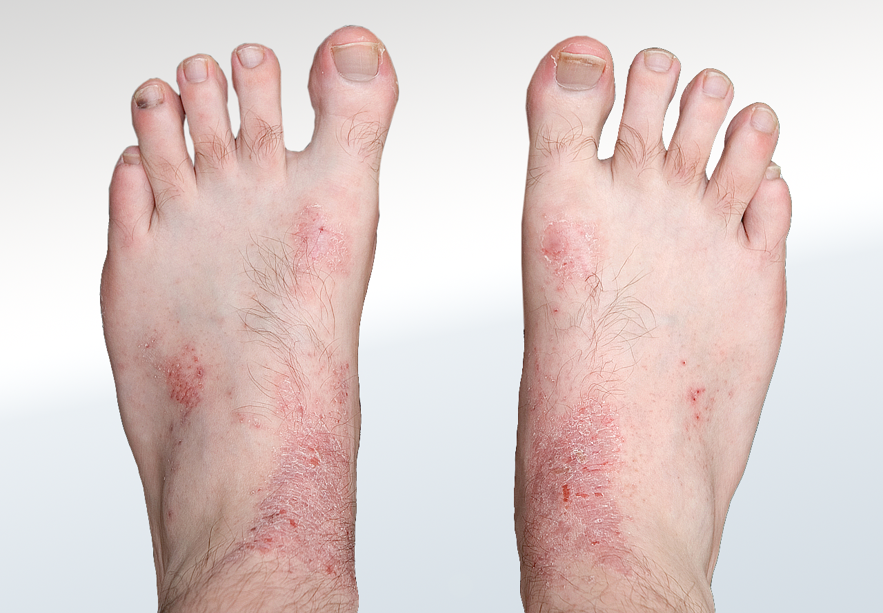 04-Skin-Foot-Dorsal-Eczema.png