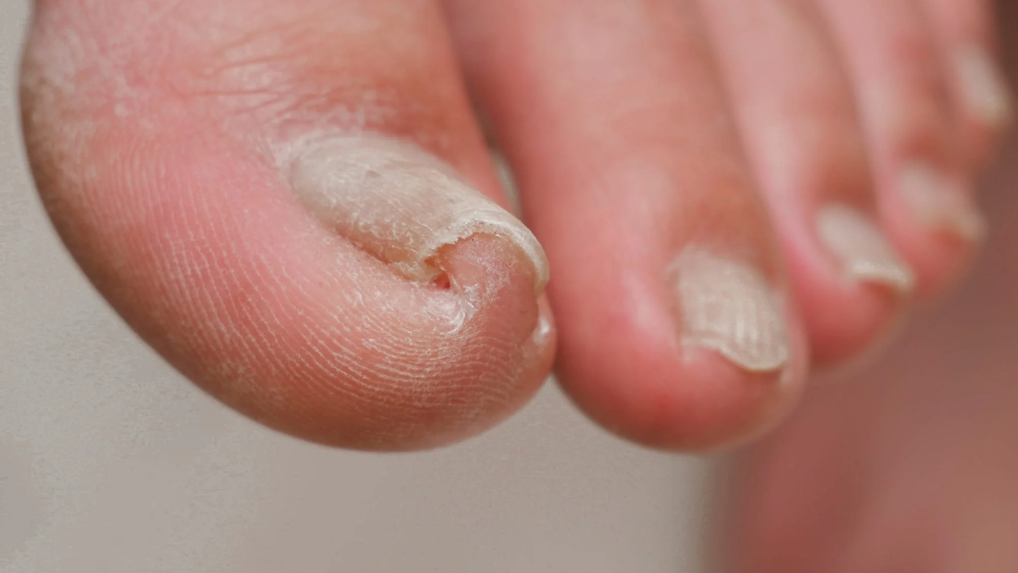 ingrown-toenail.jpg