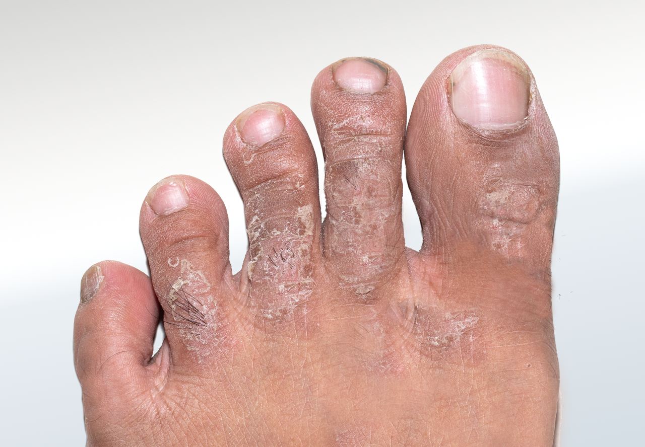 01-Skin-Toes-DistalTip-Psoriasis.png