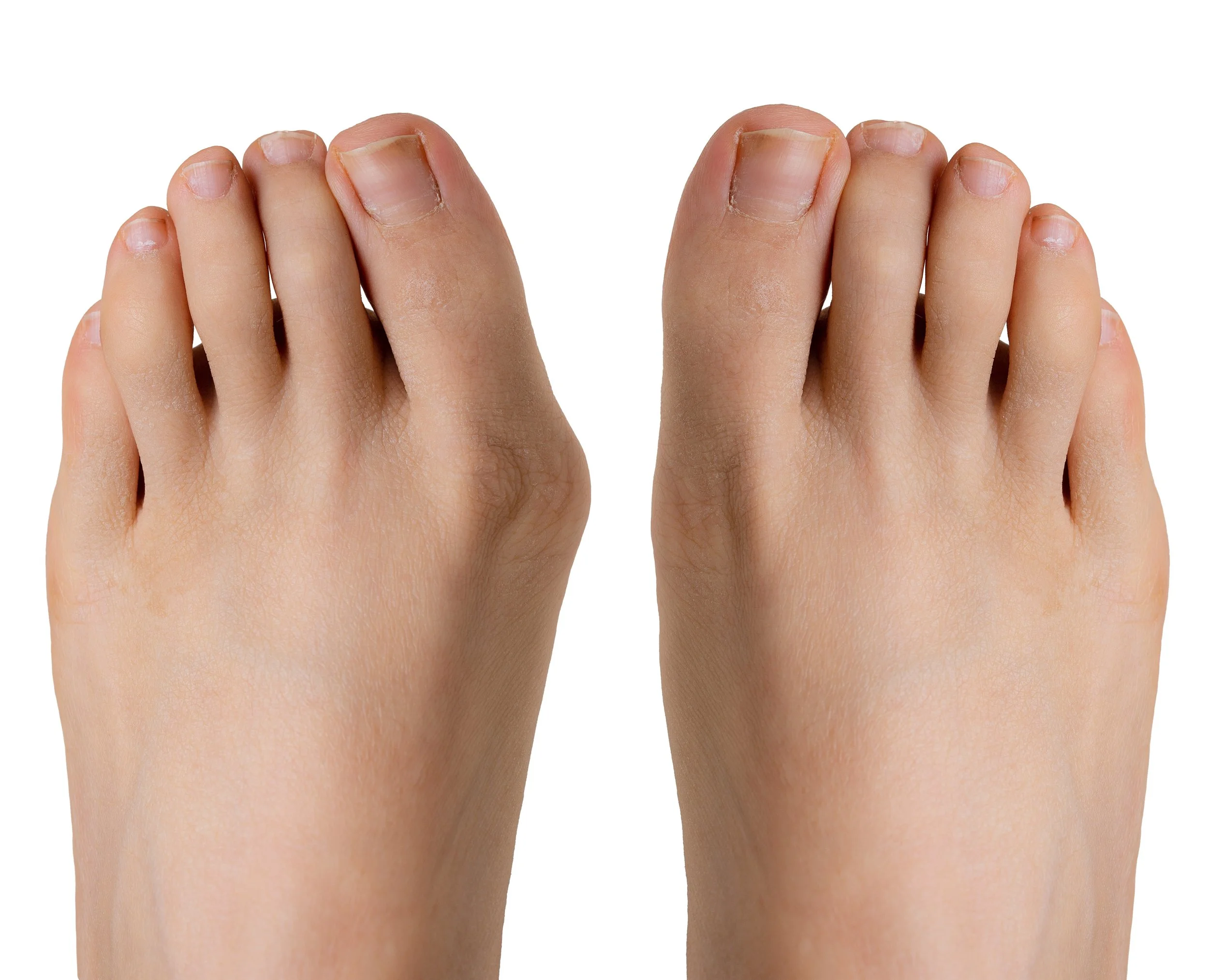 hallux-valgus-before-after-surgery.jpg