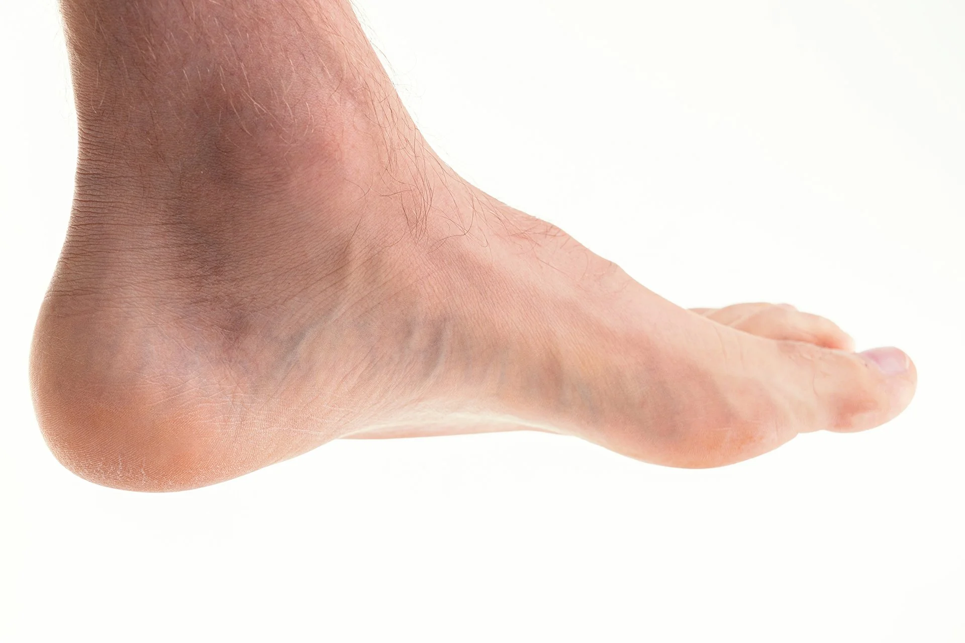high-arch-foot.jpg