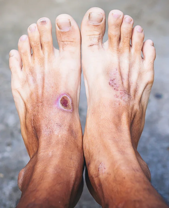 diabetic-foot-1.webp