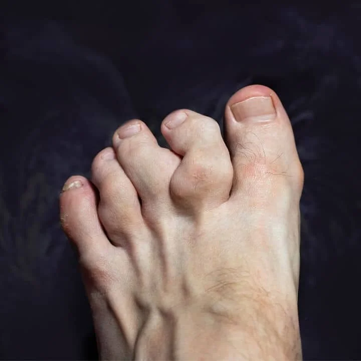 hammertoe (1).jpg