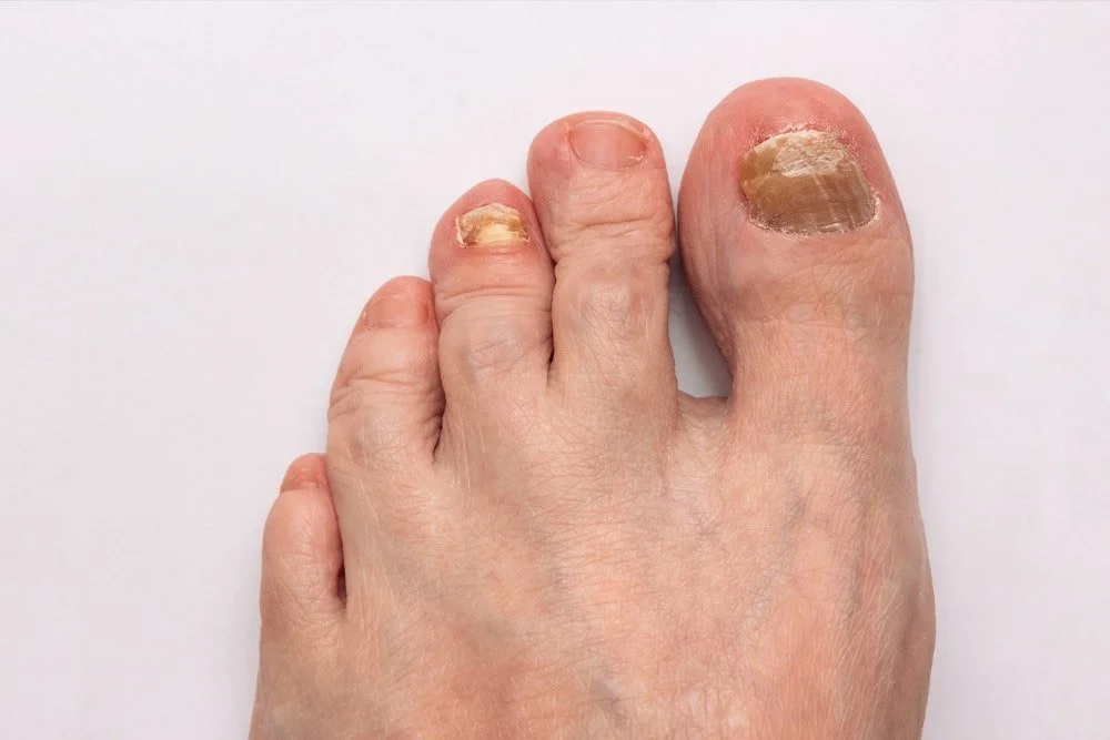 What-are-Toenail-Fungus-Thick-Nails.jpg