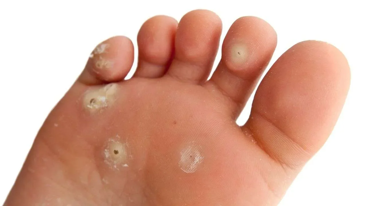 Plantar-Wart.webp
