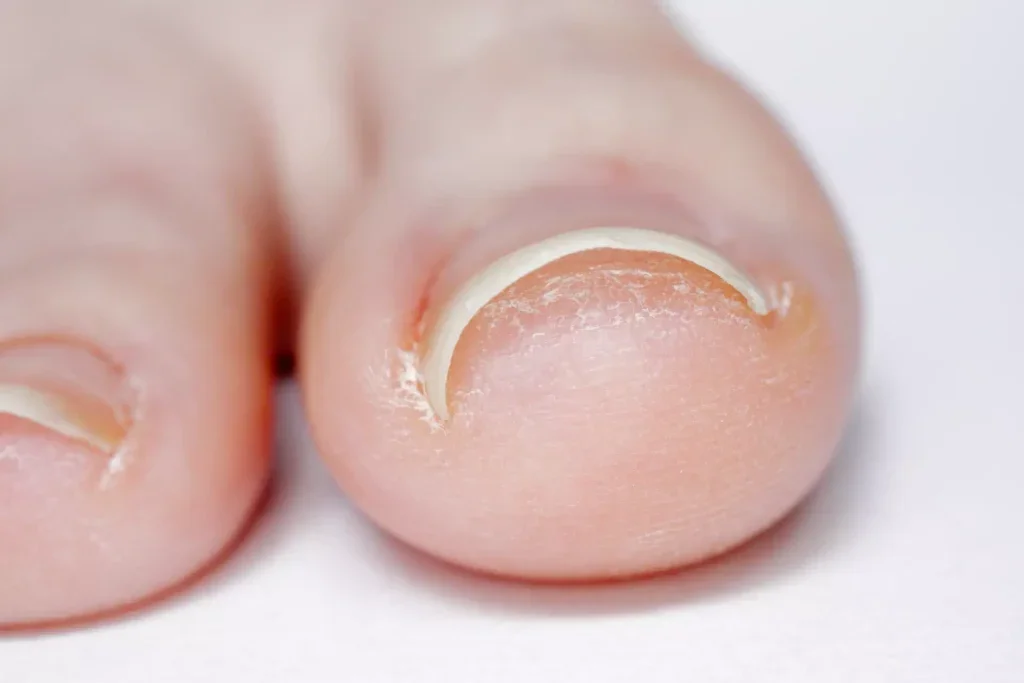 ingrown-toenails-7-1024x683.webp