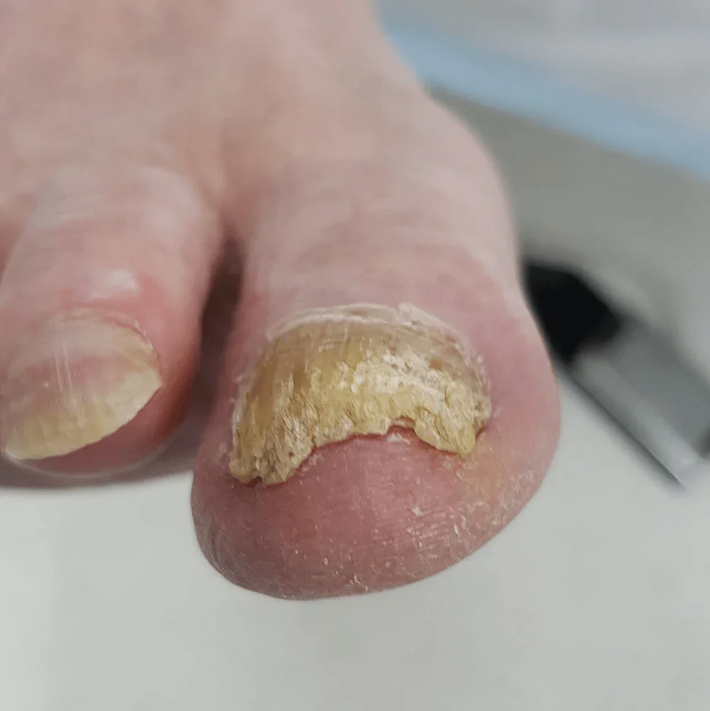 thick_fungal_toenail_big_toe_1000.webp