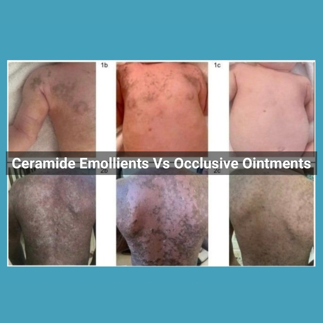 Rationale for EI Skincare - Ceramide Emollients Versus Occlusive Ointments