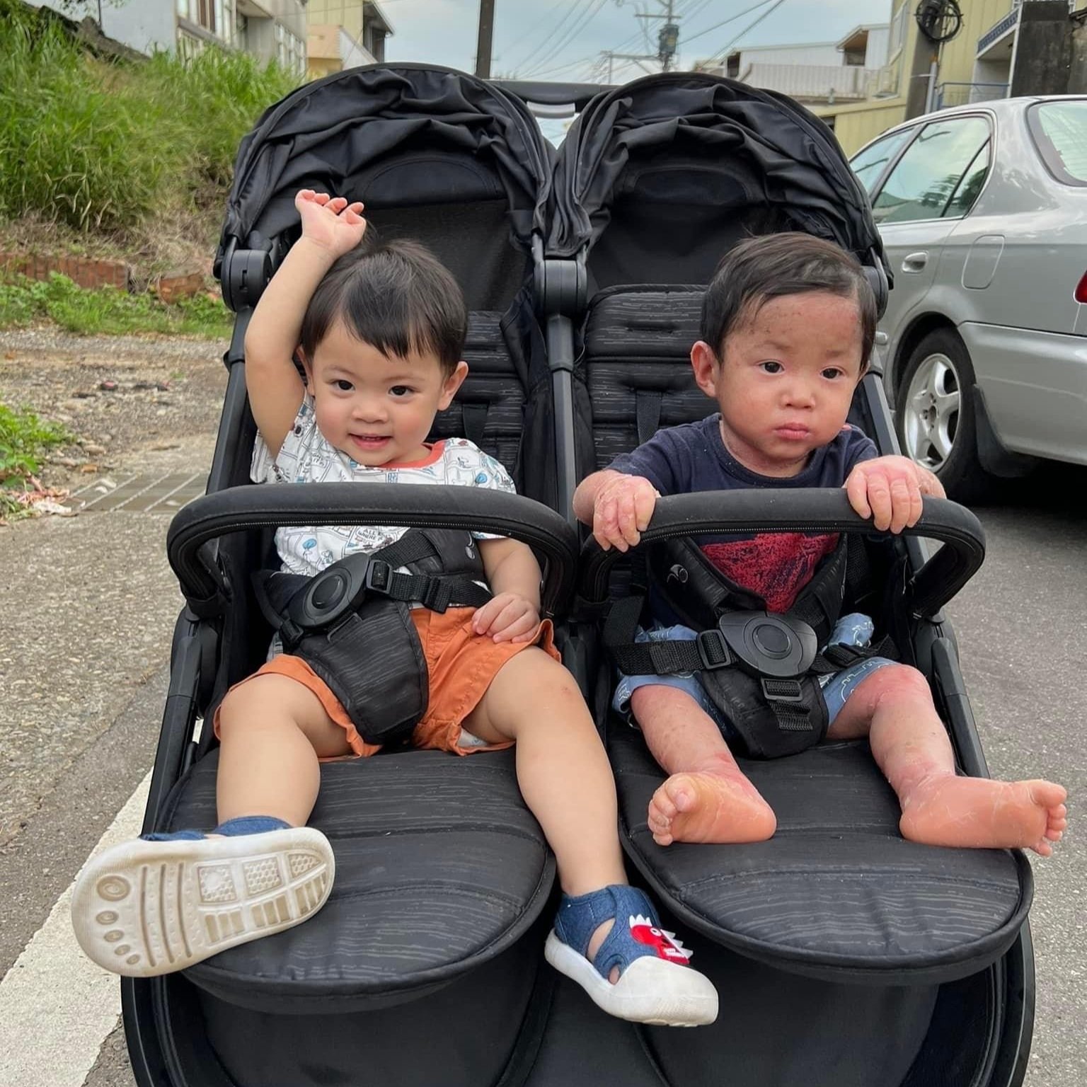 Twin boys. The smaller twin is affected with Epidermolytic Ichthyosis caused by a KRT1 genetic variant.