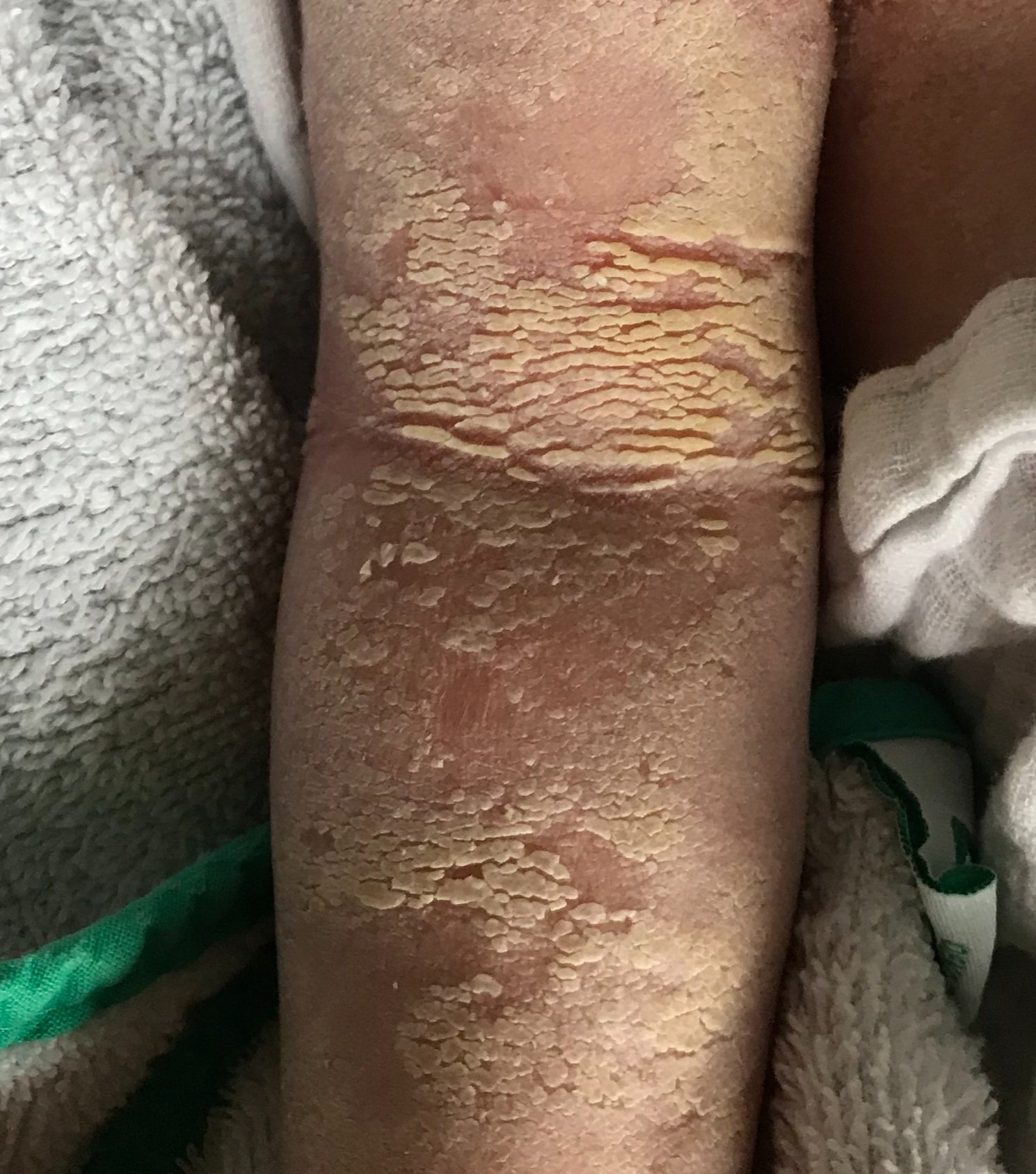 Early scale development around 3 to 4 months shown on inner arm