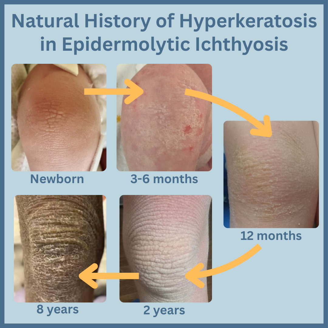 Natural History of Hyperkeratosis.PNG