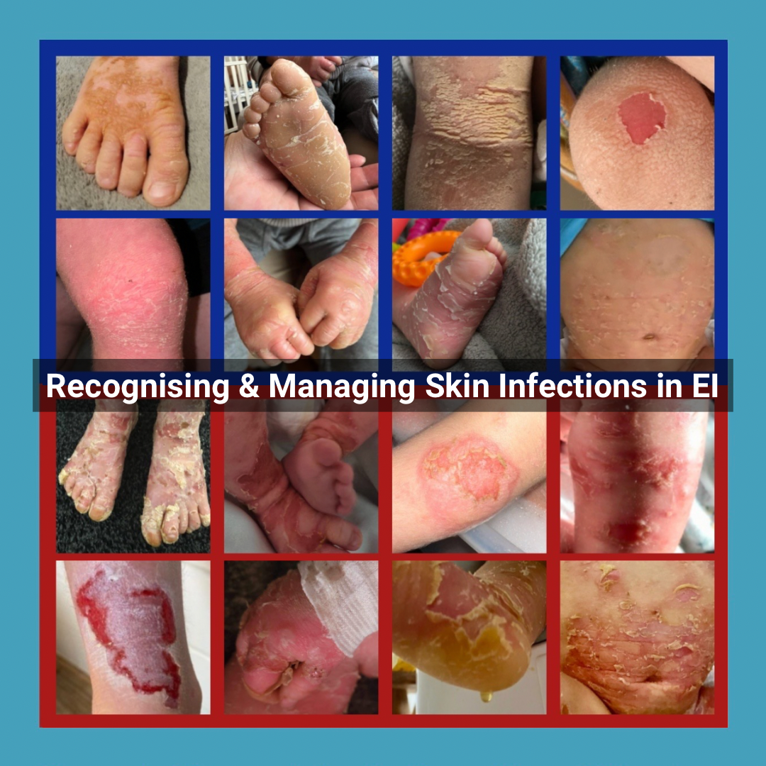 Recognising and Managing Skin Infections in Epidermolytic Ichthyosis