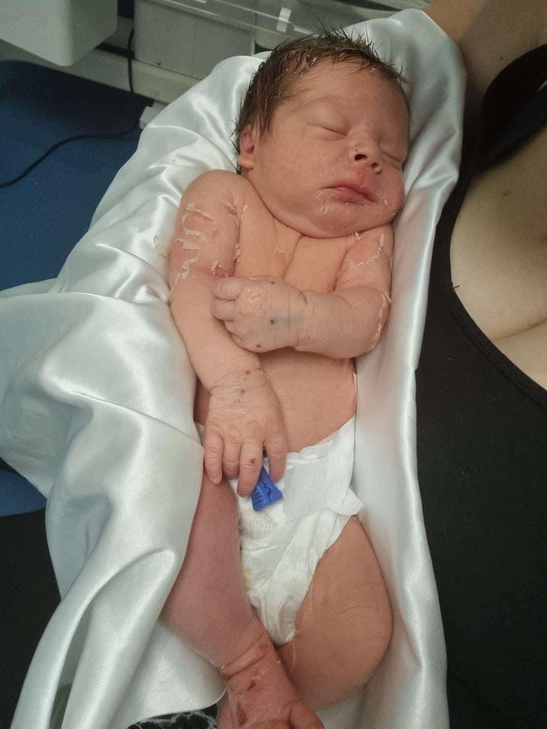 A newborn baby with Epidermolytic Ichthyosis caused by KRT10 genetic variant