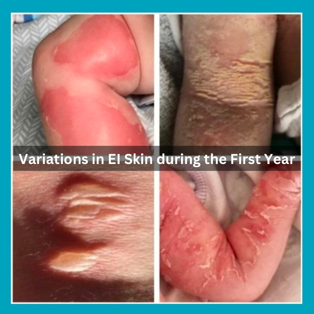 Potential variations in EI Skin during the First Year - Image Gallery