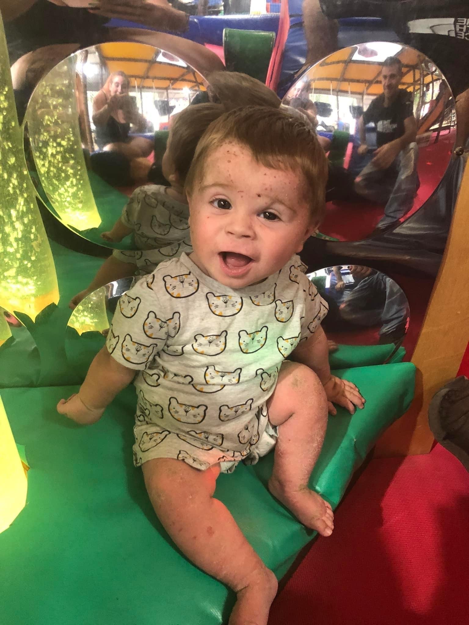 A child with Epidermolytic Ichthyosis caused by KRT10 genetic variant