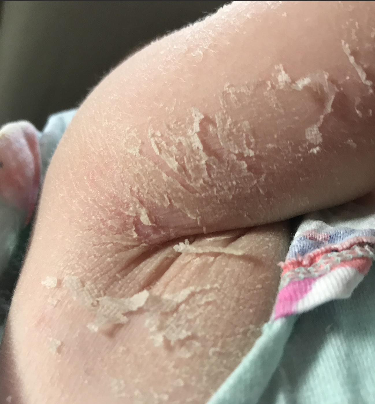 Skin dryness and flaking indicates need for a change in care routine. Addition of thicker emollients and use of wet-wrapping technique with Skinnies WEB resolved this