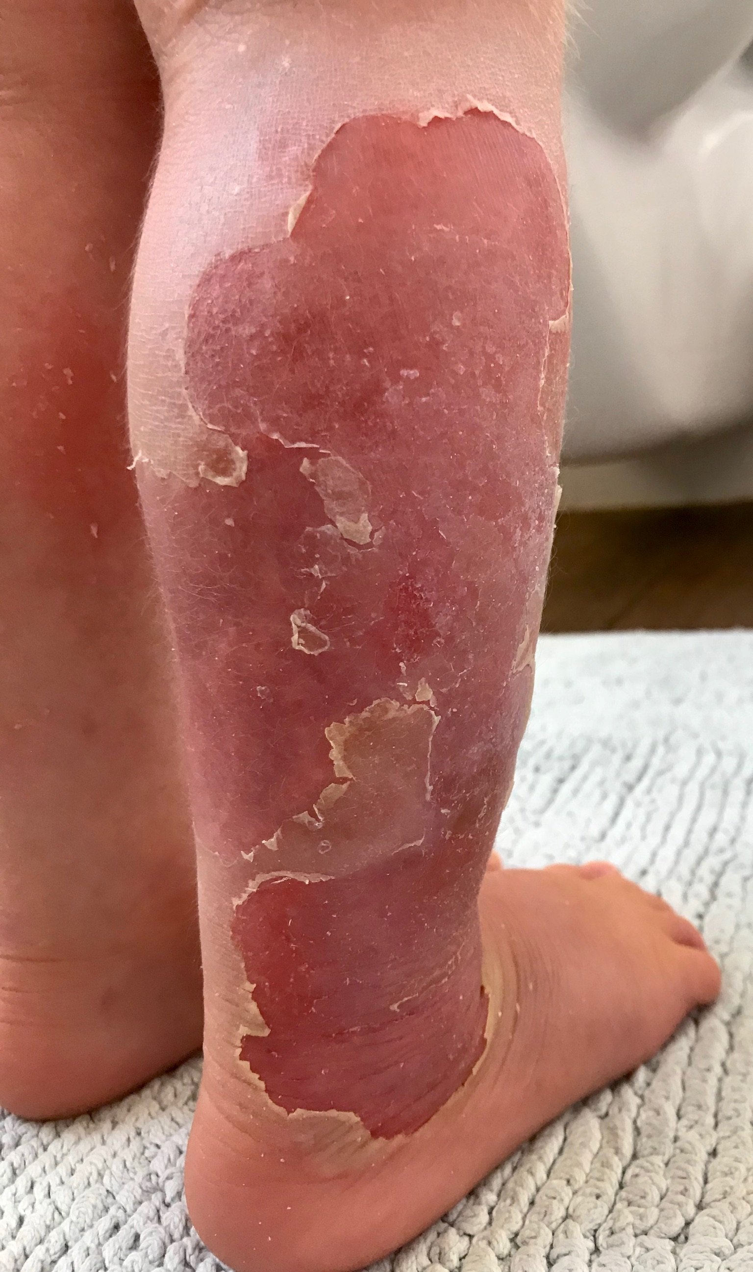 Healing skin following wound debridement and treatment of skin infection with oral antibiotics
