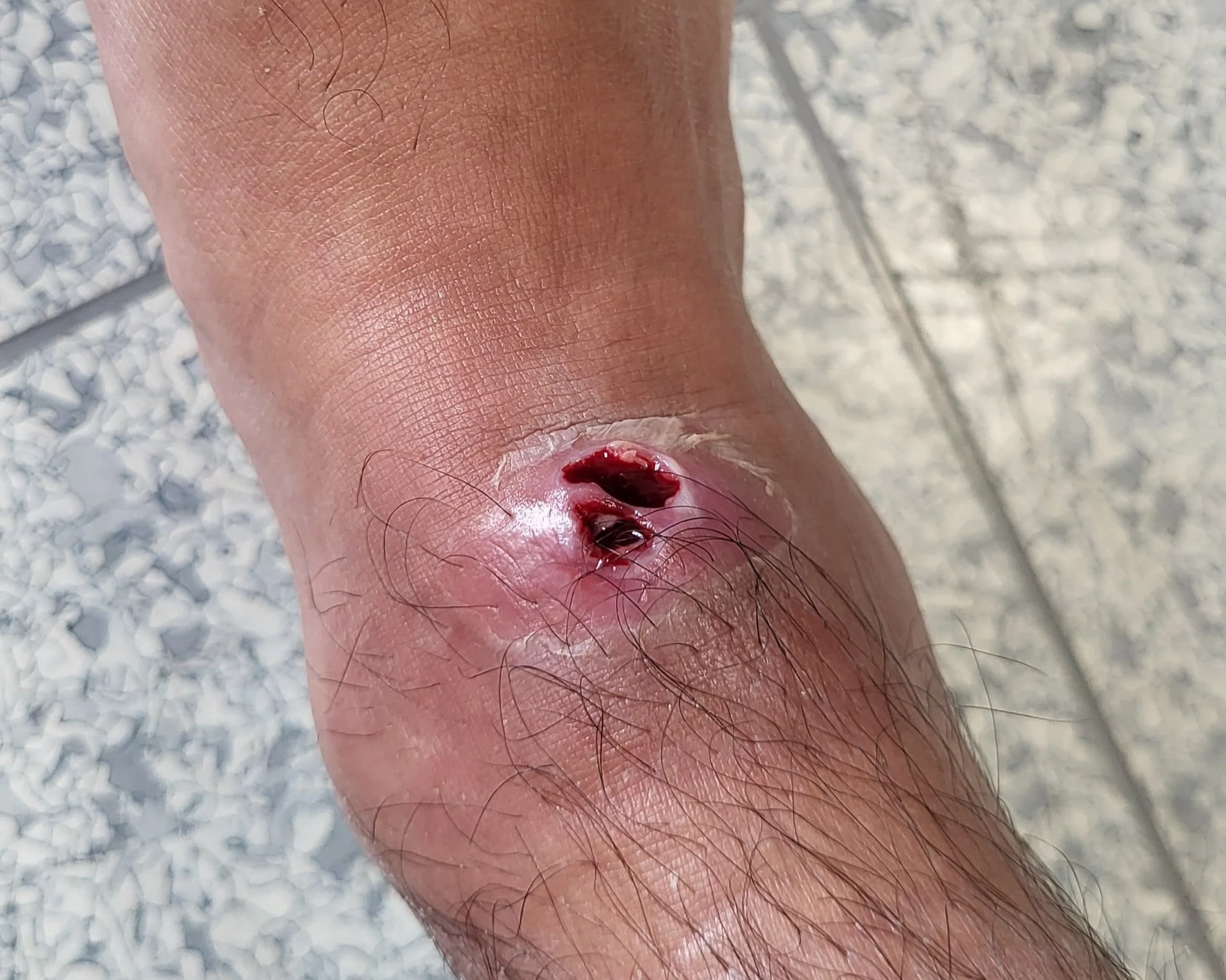 staph+infection.jpg