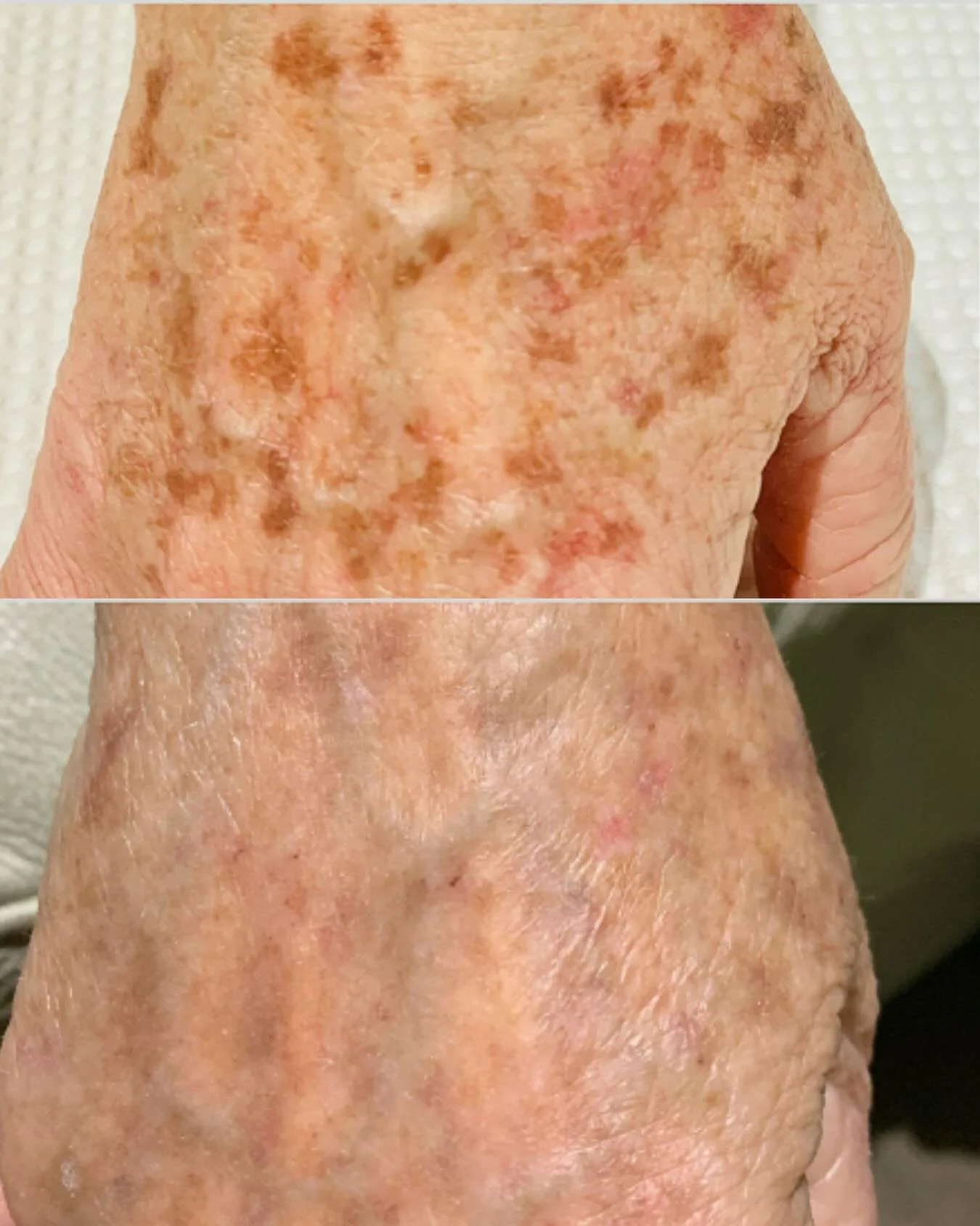 Hands are one of the first places to show visible sun damage and pigmentation&hellip; but they&rsquo;re also one of the most overlooked areas when it comes to treatment.

These results were achieved with IPL pigment reduction treatment targeting exce