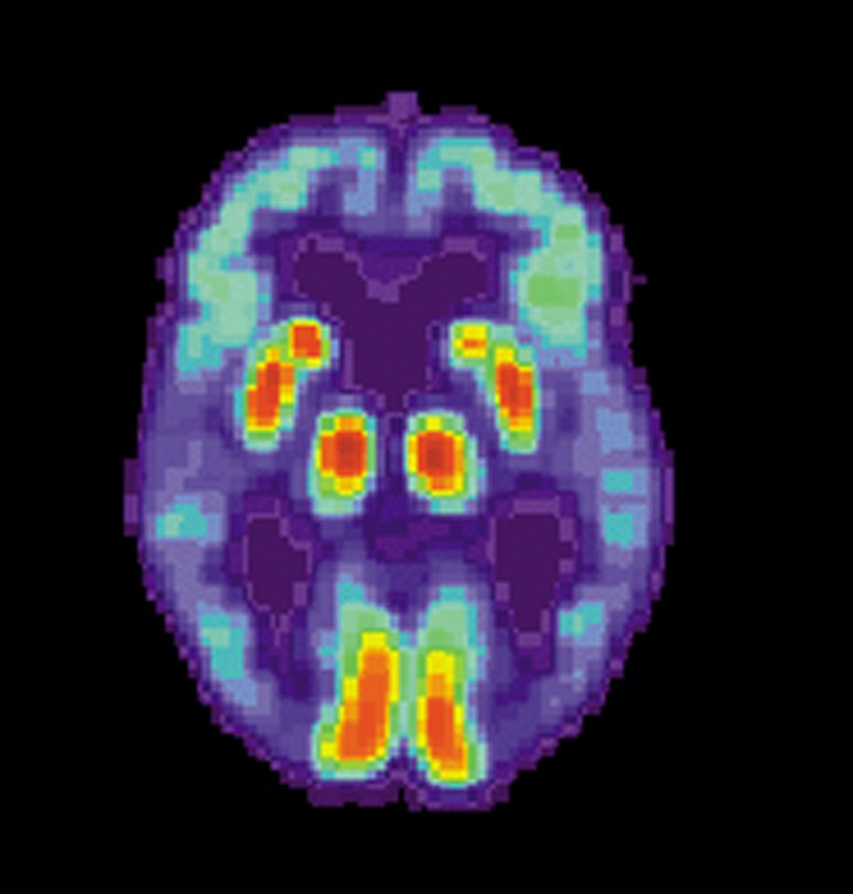 Breaking down the cause underlying the pain associated with Alzheimer's disease