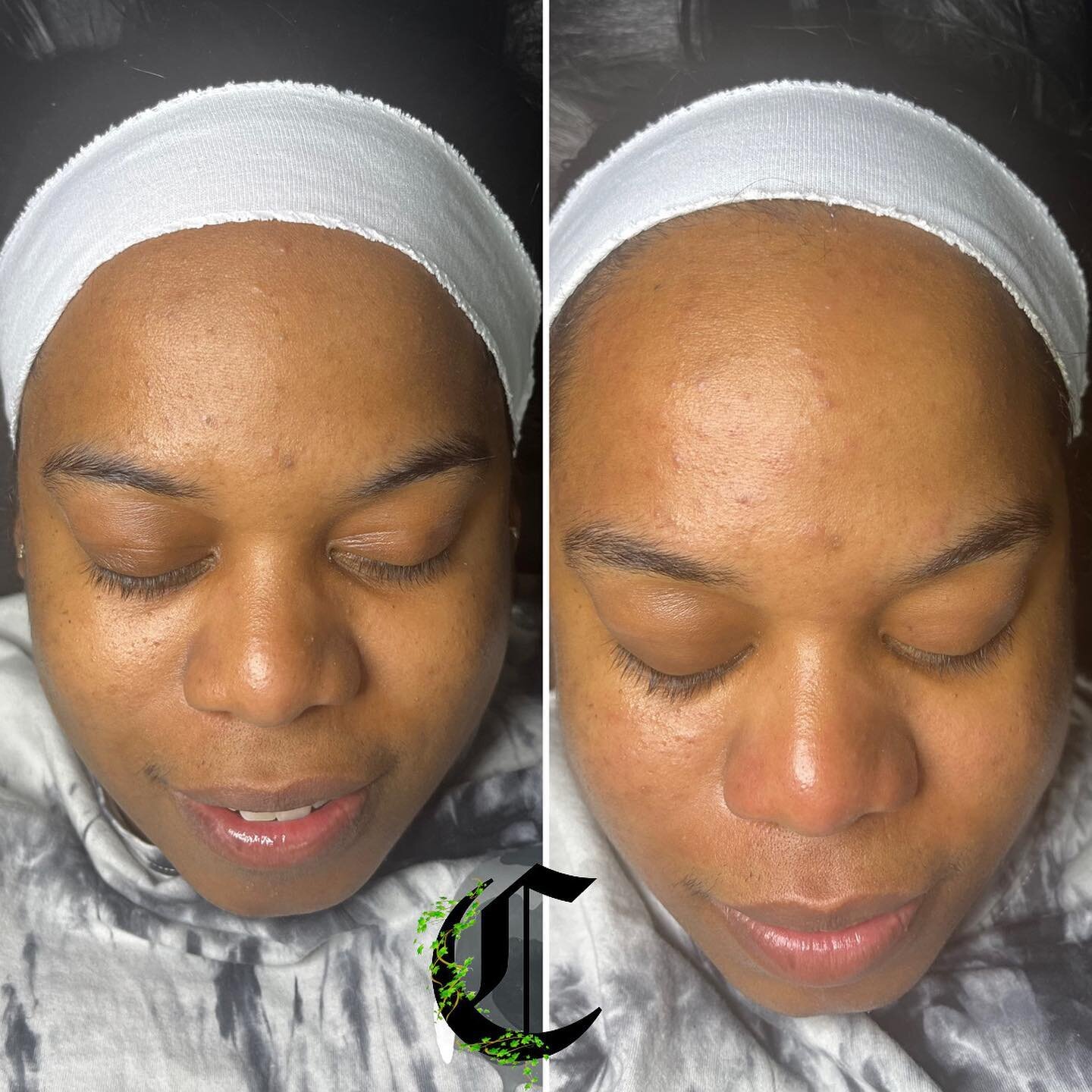 If you feel like your skin is going Berserk with breakouts .. A facial just might be the thing you need ! We can talk about The Why when you get here🤌🏿💕

#facials #facialtreatment #browardfacialspecialist #browardfacials  #esthetician  #browardest