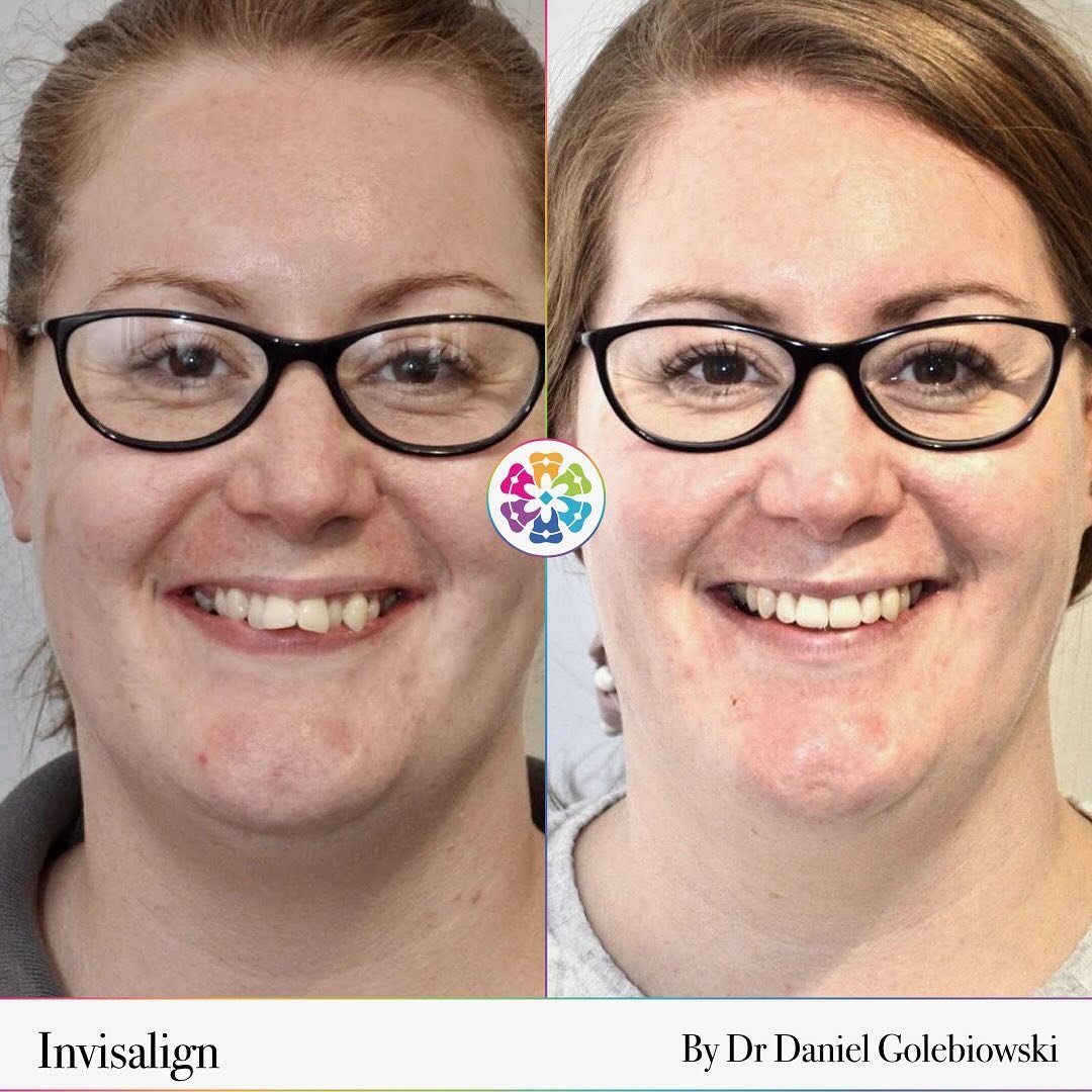 ✨ WHAT A DIFFERENCE A SMILE MAKES!✨

Throwback ⏮️⏮️ to this complex @invisalign_uk case by @dan.tistry 🦷

It was a long journey with lockdown throwing in a hurdle or two but well worth the effort.

Patient was pleased and the final comment... &ldquo
