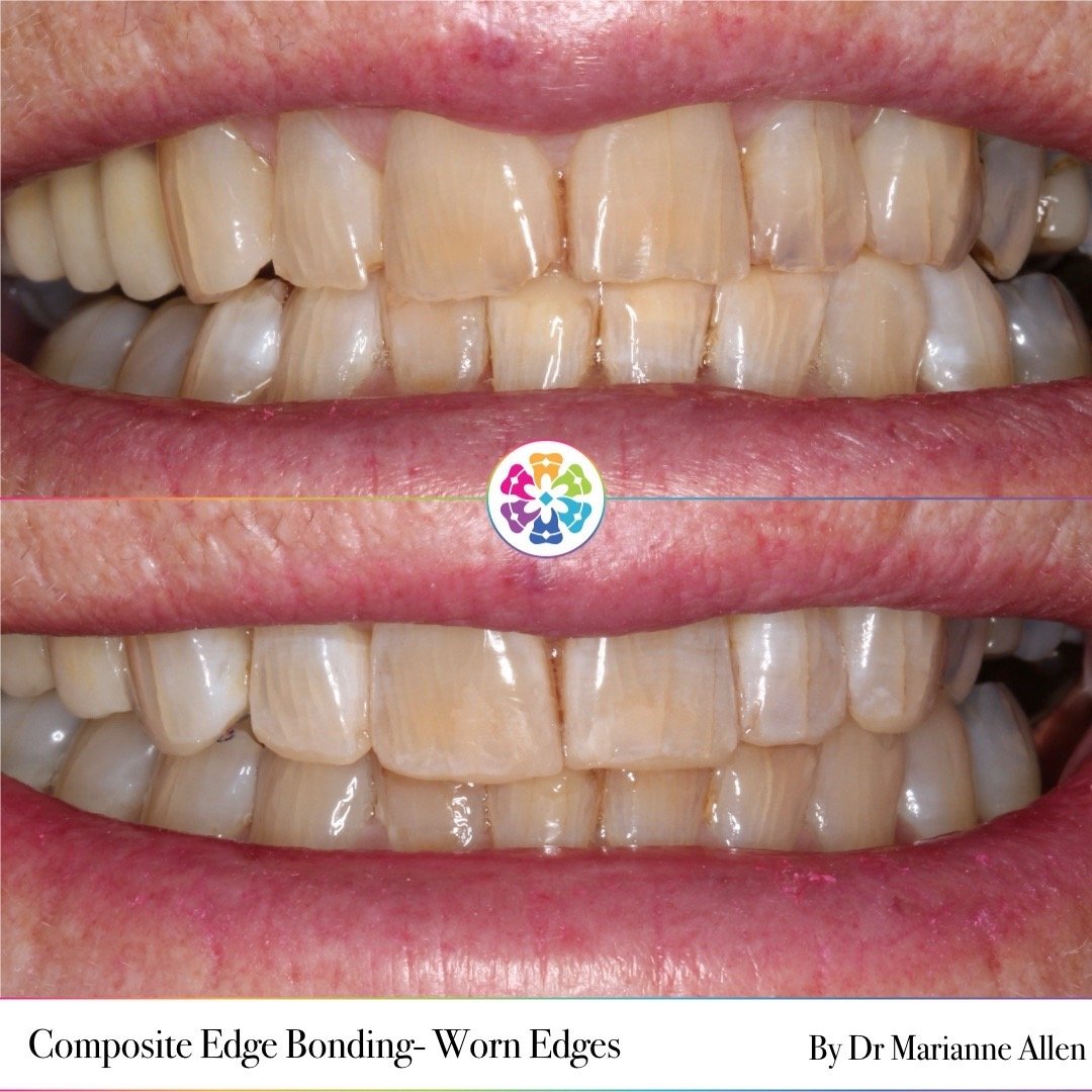 ✨Composite Edge Bonding due to worn edges ✨

3 reasons why worn incisal edges are rebuilt: 

1. Prevention: to prevent further damage as the tooth becomes thinner

2. Sensitivity: exposed dentine can cause the tooth to become more sensitive 

3. Aest