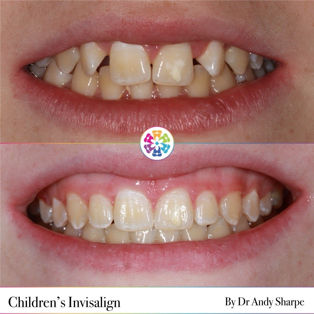 ✨Child&rsquo;s Invisalign✨

This patient was concerned about the gaps in his teeth. 

He started Invisalign and was finished before he knew it, the whole treatment only took 7 months from start to finish! 

Safe to say he was over the moon! 

#invisa