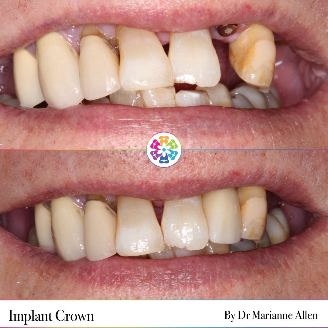 ✨Implant crown✨

This patient was not keen on his current denture, they wanted a more permanent fix.
Dr Andrew Sharpe placed the implant for this patient, then Dr Marianne Allen placed the implant crown (the tooth)

The patient is very happy with the