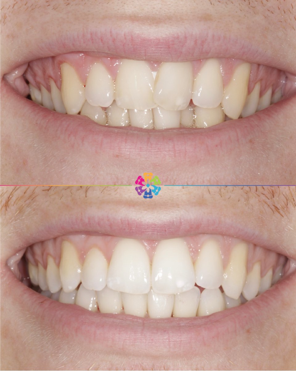Invisalign before and after completed at Dental Smiles Takeley🦷

This patient had crowding on the lower arch and overlapping front teeth, this was corrected using Invisalign, we also placed a bonded retainer behind the lower anteriors to ensure ther