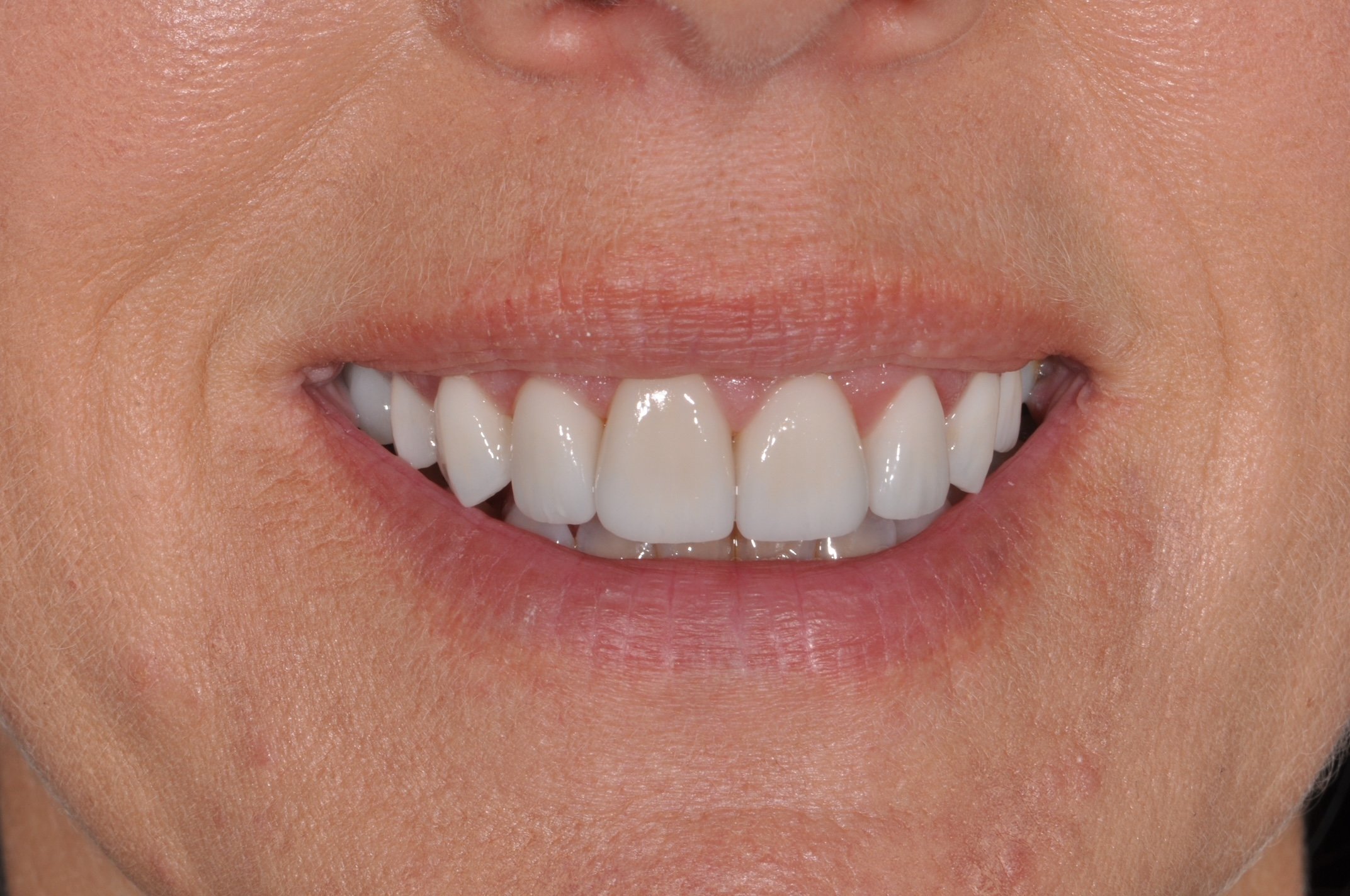 After Veneers