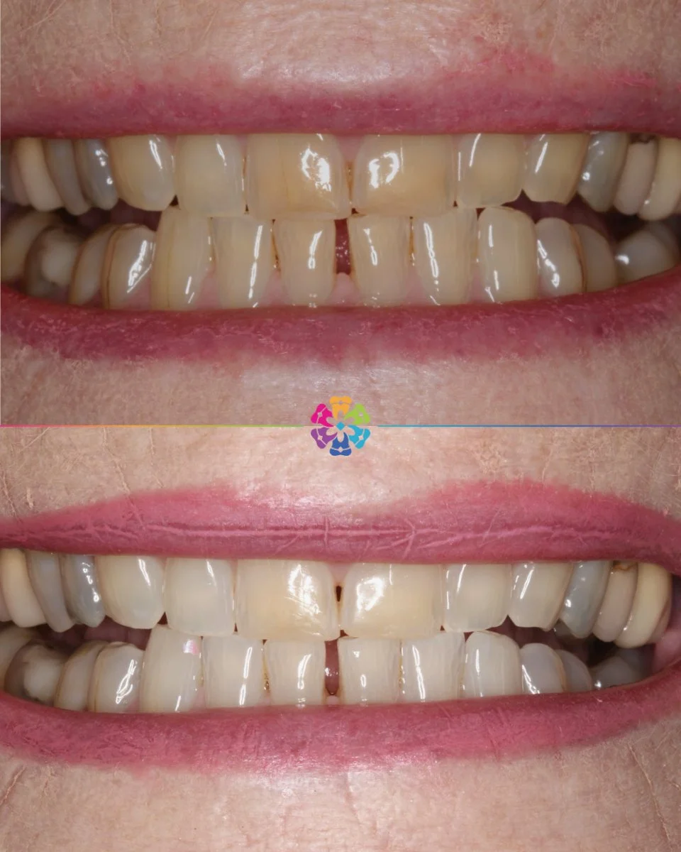 Boutique Whitening 🌟

Teeth whitening can be done to your preference to make your teeth as white as possible or more of a natural brightness!

With boutique whitening, you can stop whitening whenever you are happy with the shade, or even top up a bi