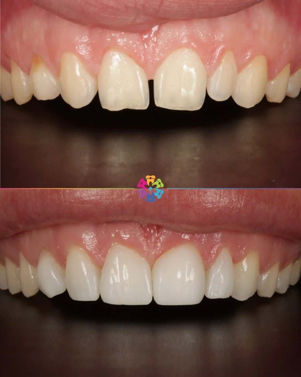 Composite Veneers ✨

Same day results⏱️

Stunning, natural results by Dr Katy Sharpe 🦷

#dentist #dentalsmiles #dentalsmilesessex #dentalsmileschelmsford #dentalsmilesessex #dentalsmilestakeley #essex #compositefillings #veneers #invisalign #dentalt