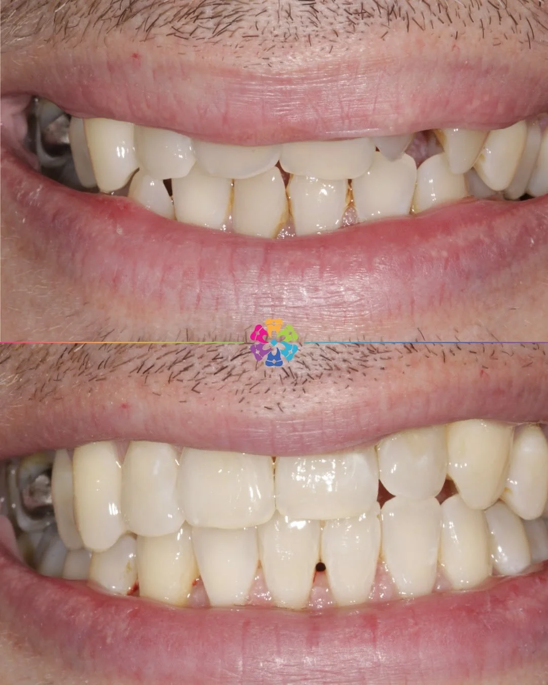 Invisalign case in less than one trip around the sun ☀️

In just 364 days this smile was transformed ⏱️

This case had some severe rotations on the upper arch. Check out the video to see the movement timeline 🦷

We offer free Invisalign consultation