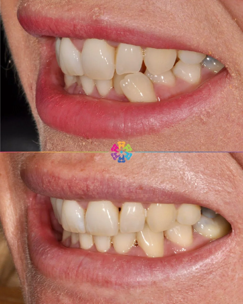 Invisalign Case 💫

This case involved a premolar extractions with elastics to correct the lower severe crowding 🦷

A touch of composite bonding to restore the worn edge!

Fantastic result by Dr Dan Golebiowski👨🏽&zwj;⚕️

#dentist #dentalsmiles #de