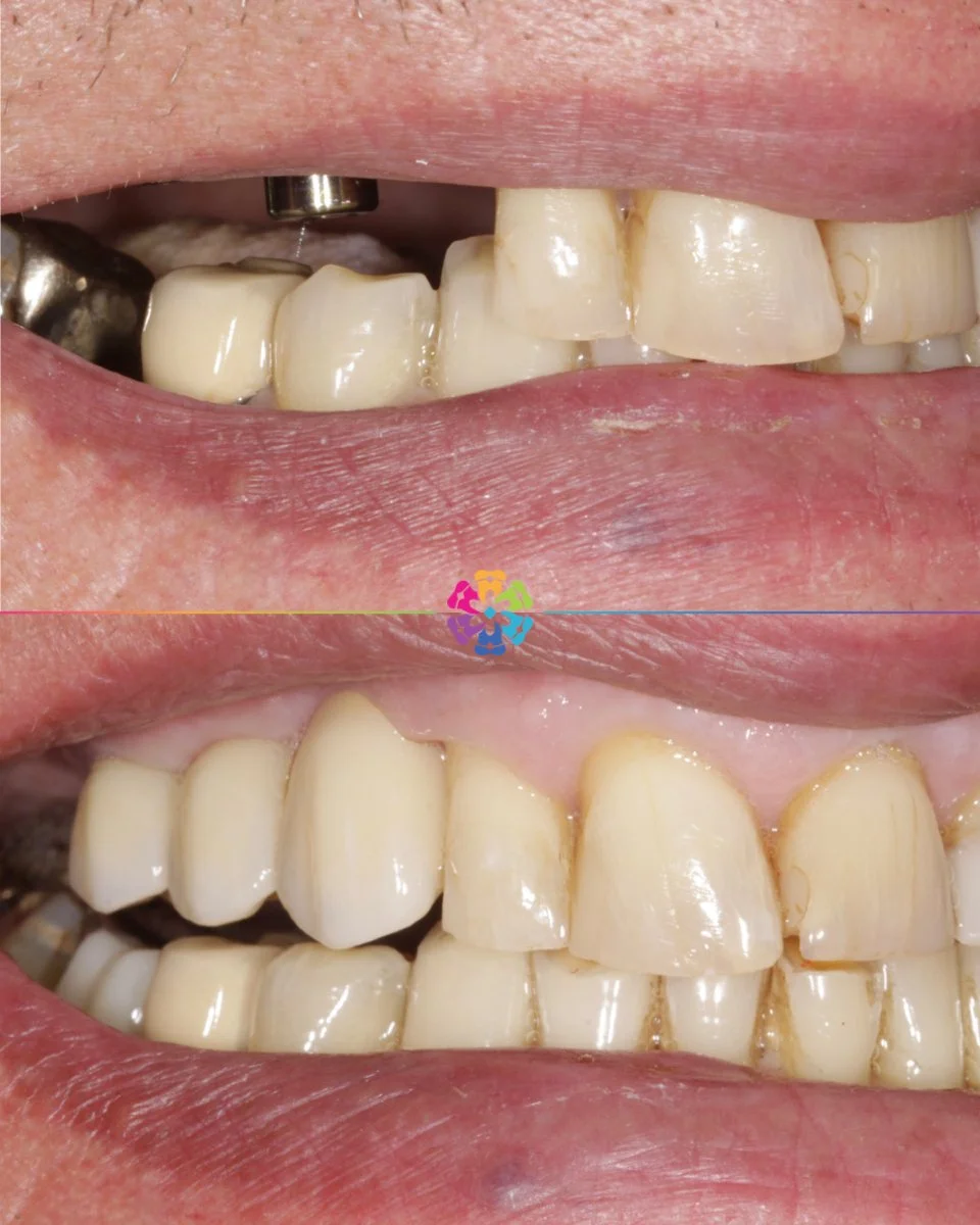 Implant Transformation 🔩

What is a Dental Implant?

A dental implant is a titanium screw that is surgically placed into the jawbone, acting as a replacement for the root of a missing tooth. Over time, the implant fuses with the jawbone, providing a