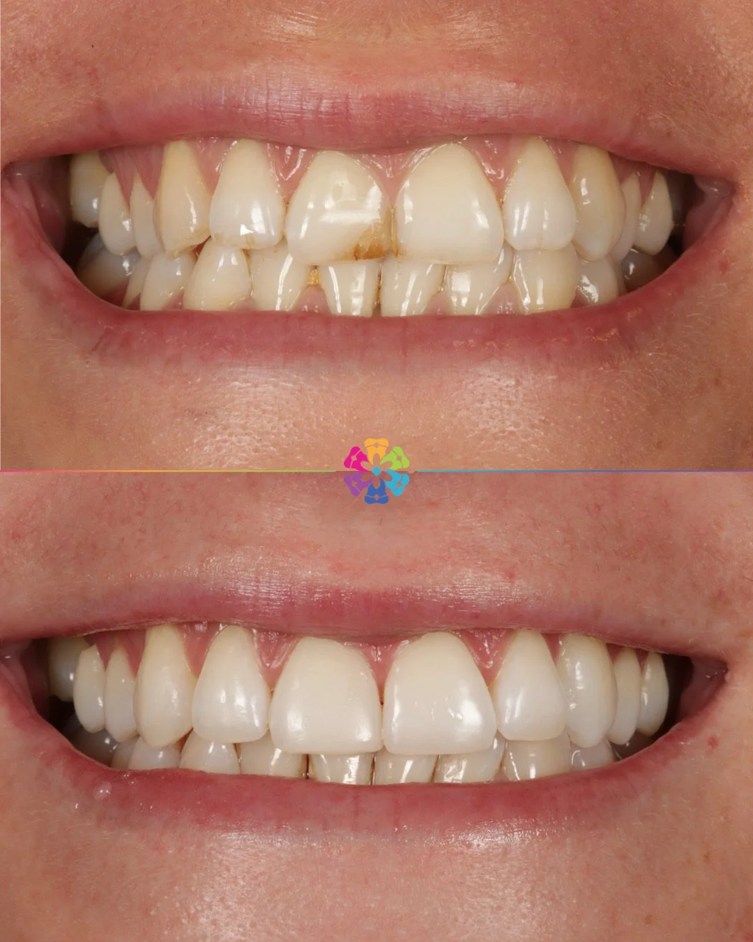 Invisalign, Whitening &amp; Composite Edge Bonding 💫

Dr Katy Sharpe working her magic 🪄 

#dentist #dentalsmiles #dentalsmilesessex #dentalsmileschelmsford #dentalsmilesessex #dentalsmilestakeley #essex #compositefillings #veneers #invisalign #inv