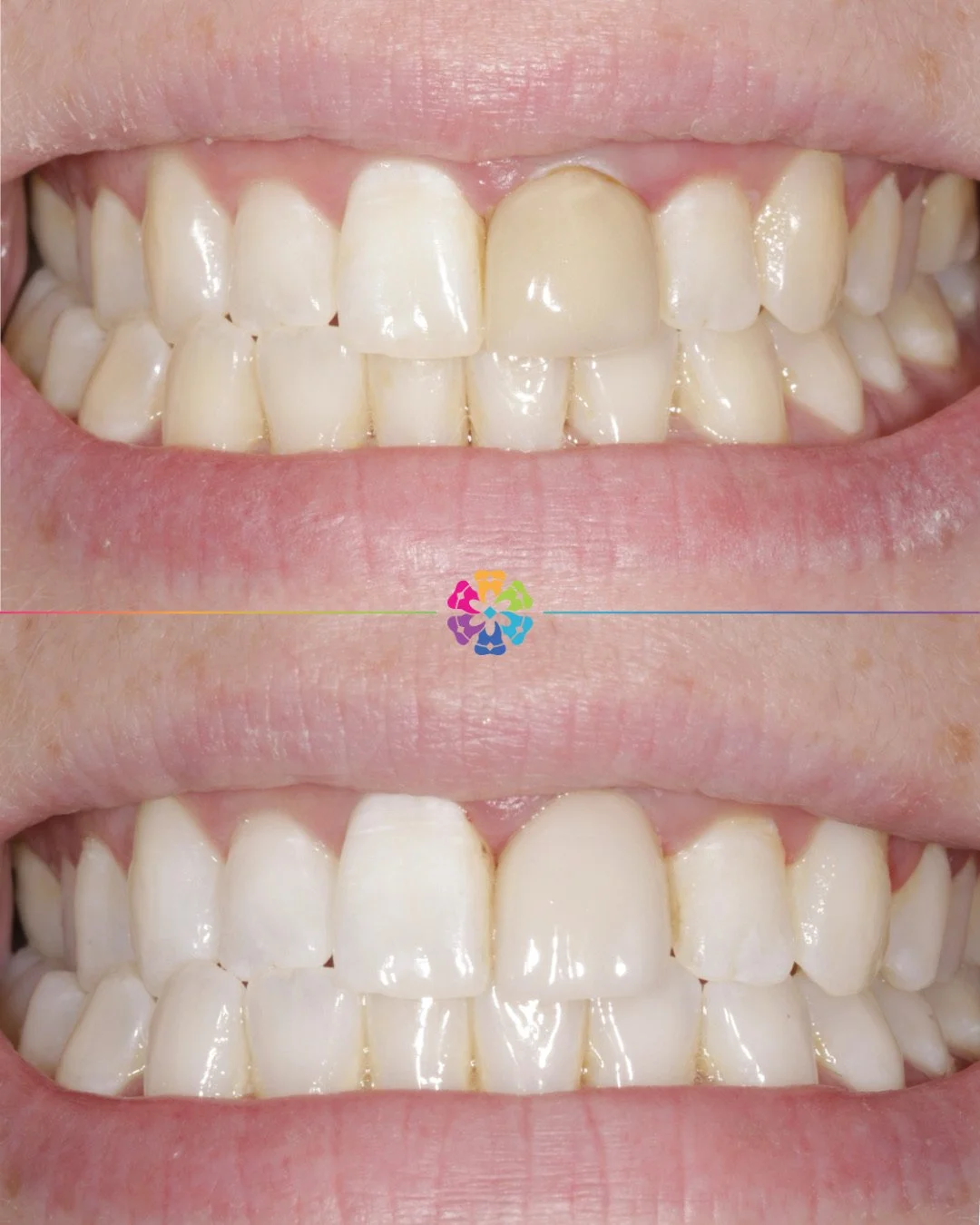 Replacement Crown 👑 

After further treatment on this tooth and whitening to the rest of the teeth, the crown no longer blended in 🦷

Dr Sharpe replaced the crown to a better shade and aesthetic!

#dentist #dentalsmiles #dentalsmilesessex #dentalsm