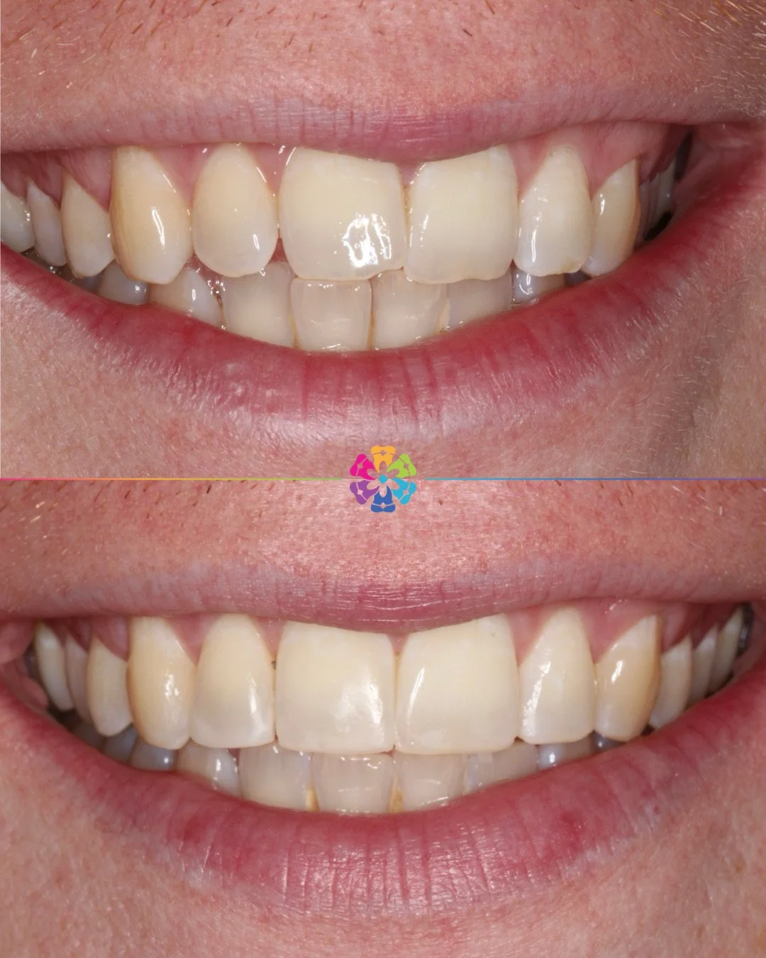 Invisalign &amp; Composite Bonding 🦷

Creating perfect smiles at Dental Smiles ✨

#dentist #dentalsmiles #dentalsmilesessex #dentalsmileschelmsford #dentalsmilesessex #dentalsmilestakeley #essex #compositefillings #veneers #invisalign #invisalignden