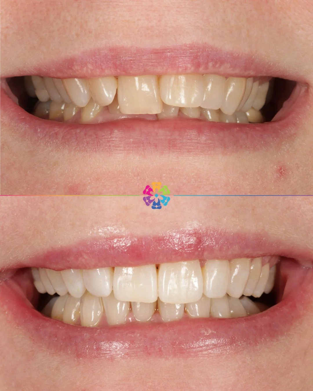 Invisalign Magic 🪄

Creating beautiful smiles to last a lifetime 🌟

Start you Invisalign journey today! We offer FREE consultations 🦷

#dentist #dentalsmiles #dentalsmilesessex #dentalsmileschelmsford #dentalsmilesessex #dentalsmilestakeley #essex